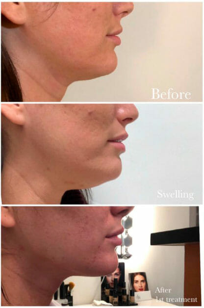 Chin Fat Reduction: Say Goodbye to That Double Chin!